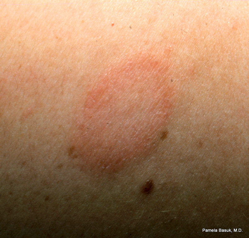 Pityriasis Rosea BASUK DERMATOLOGY